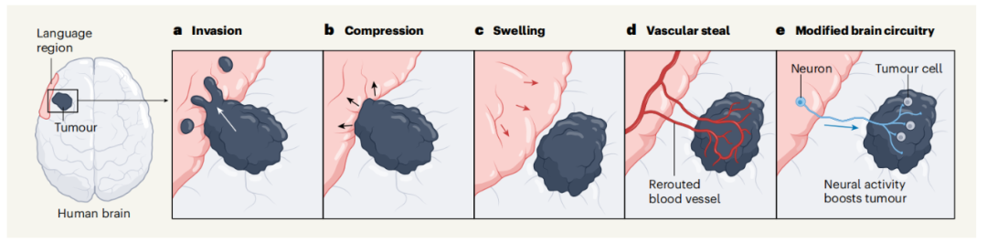 Nature颠覆性发现：大脑思考，促进肿瘤生长！胶质瘤通过劫持神经元影响认知和生存